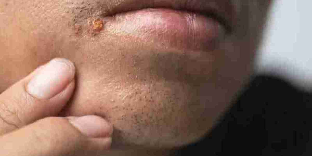 Say goodbye to cold sores: Practical advice for prevention and treatment